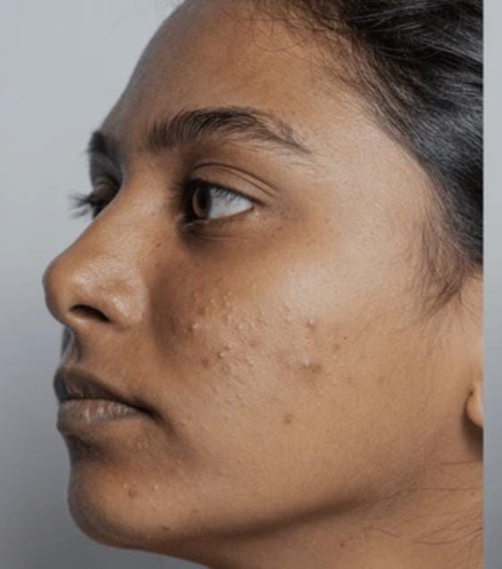 Side profile of a woman with her natural, untreated skin visible before applying any makeup.